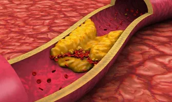Как да понижим холестерола си – 3 лесни и бързи трика